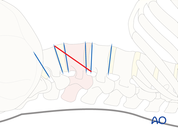 Thoracic and lumbar pathologies: Minimally invasive lumbotomy (L2-L4)