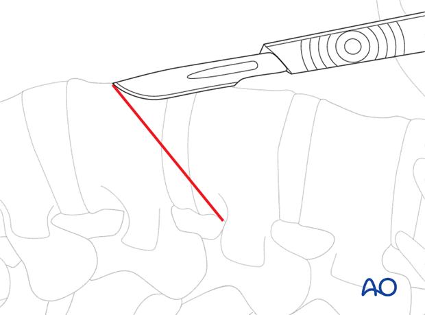 Thoracic and lumbar pathologies: Minimally invasive lumbotomy (L2-L4)