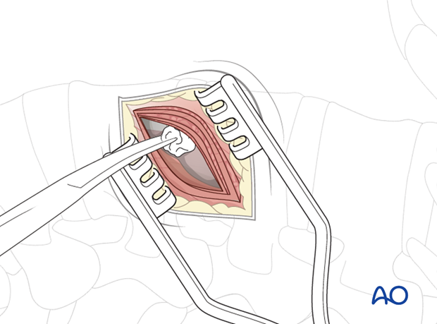 Thoracic and lumbar pathologies: Minimally invasive lumbotomy (L2-L4)