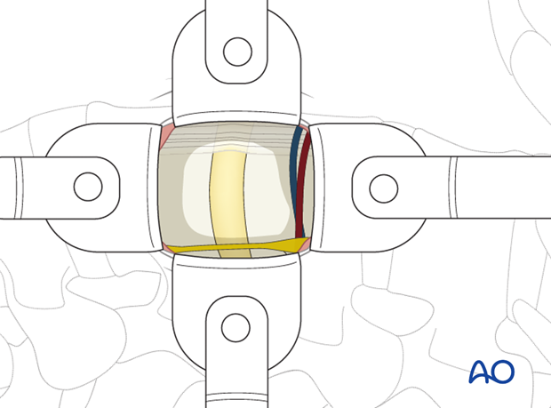 Thoracic and lumbar pathologies: Minimally invasive lumbotomy (L2-L4)