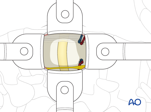 Thoracic and lumbar pathologies: Minimally invasive lumbotomy (L2-L4)