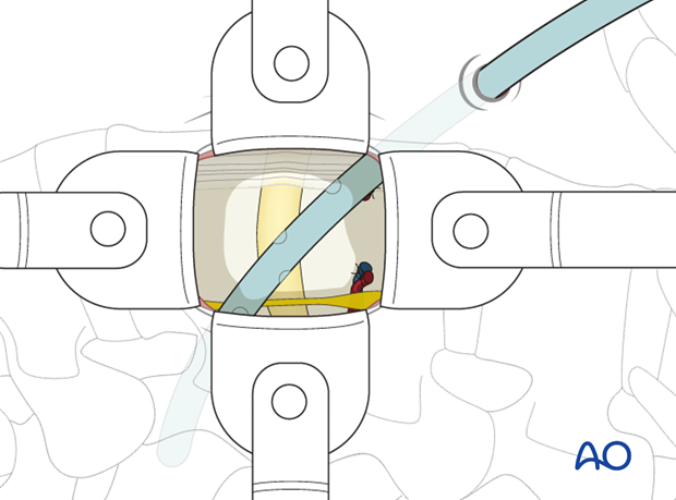 Thoracic and lumbar pathologies: Minimally invasive lumbotomy (L2-L4)