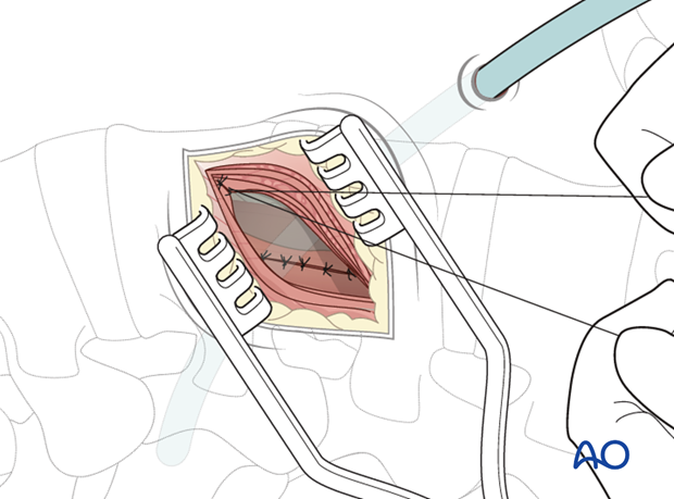 Thoracic and lumbar pathologies: Minimally invasive lumbotomy (L2-L4)