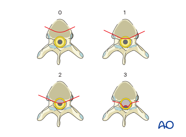 spinal cord compression scale