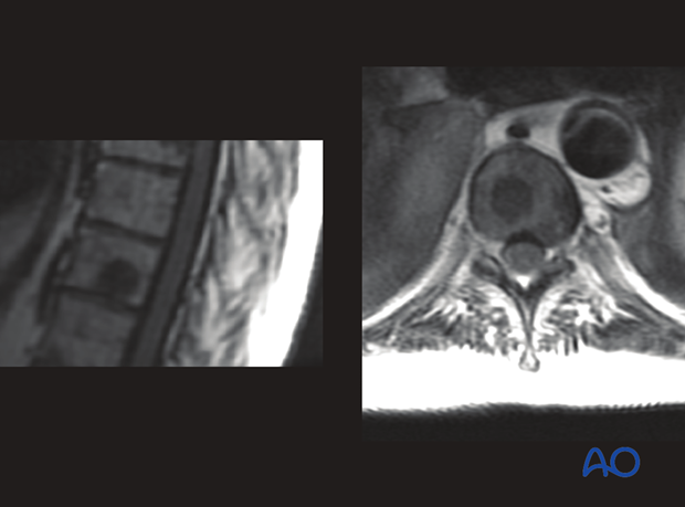 spinal cord compression scale