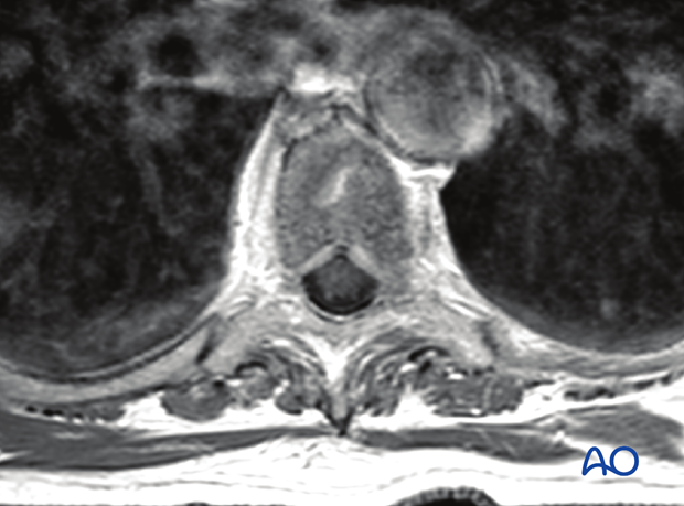 spinal cord compression scale