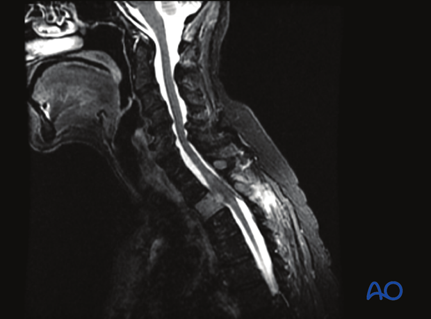 spinal cord compression scale