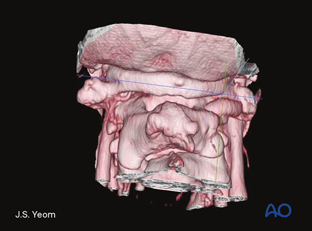 posterior midline approach to c0 to c2