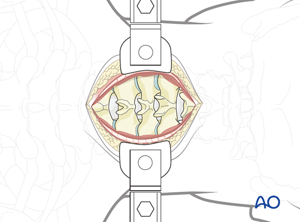 Approach should be wider to see also C3 and C7