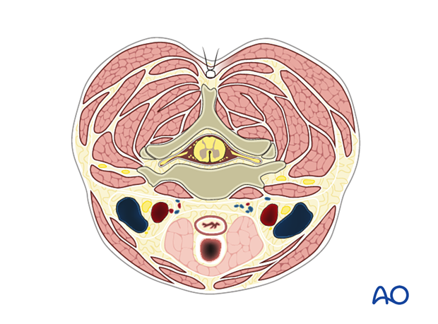 After surgical fixation and decompression muscles are approximated during posterior access to the cervical spine