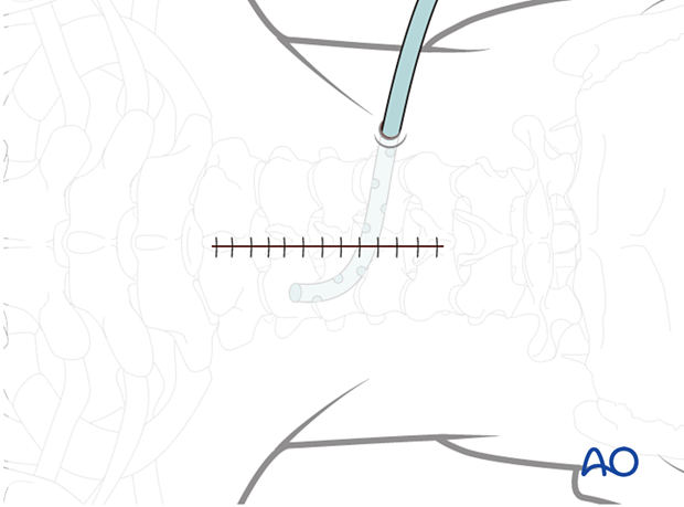 subcutaneous layers and skin are sutured during posterior access to the cervical spine