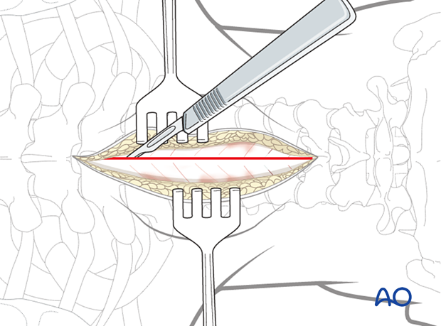 Dissection of posterior midline approach 