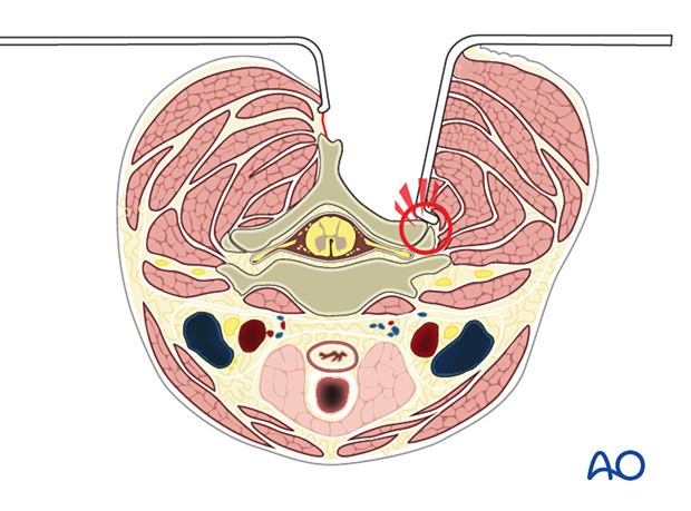 During exposure, care is taken not to injure the facet joint capsule