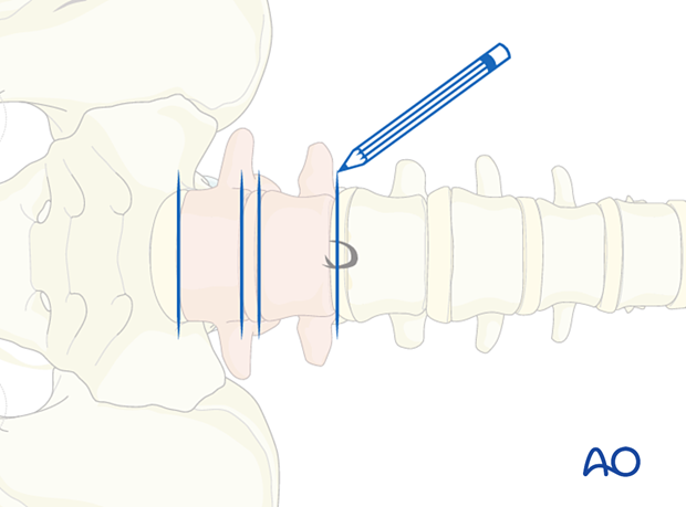 Thoracic and lumbar fractures: Mini open retroperitoneal approach (L4-S1)