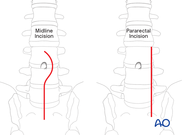 Lines of a planned chevron olecranon osteotomy