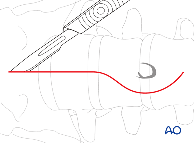 Thoracic and lumbar fractures: Mini open retroperitoneal approach (L4-S1)