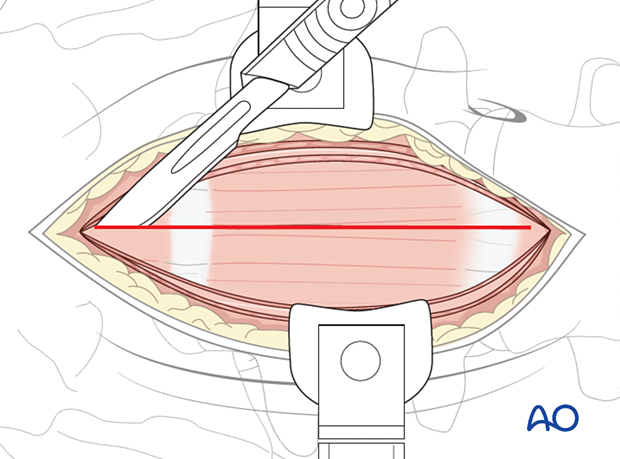 Thoracic and lumbar fractures: Mini open retroperitoneal approach (L4-S1)