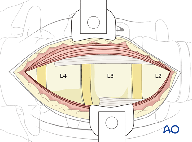 56b A070 anterior mini approach to the lumbar spine