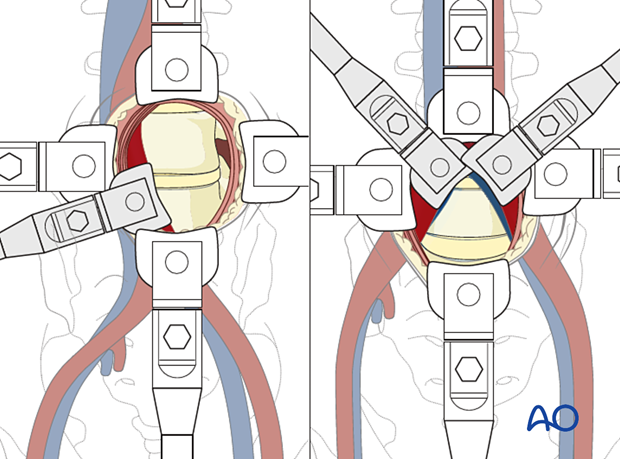 Thoracic and lumbar fractures: Mini open retroperitoneal approach (L4-S1)