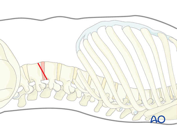 Portal site for minimally invasive transpsoas approach