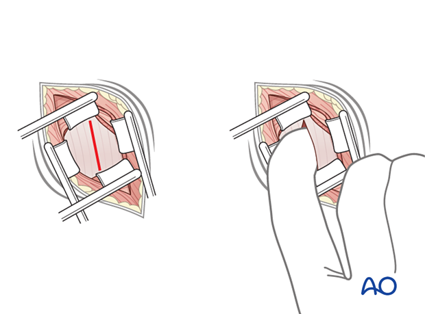 Opening the fascia of the transverse abdominal muscle during a minimally invasive transpsoas approach