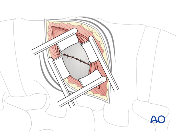 Repairing a damaged peritoneum