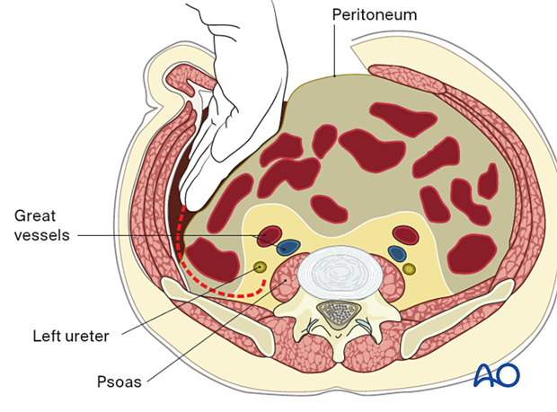 Sweeping the intraperitoneal contents superiorly, inferiorly, and medially to reveal the spinal column in the midline during the Retroperitoneal approach for Anterior lumbar interbody fusion (ALIF).