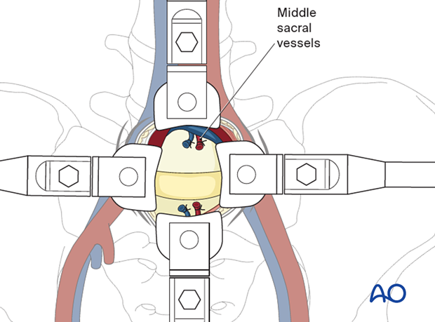 57b A720 Retroperitoneal approach for ALIF