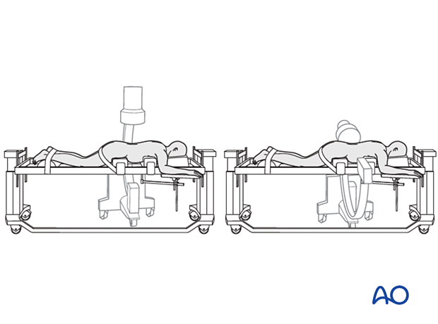 C-arm in AP and lateral position while the patient is in a prone position for approaches to the lumbar spine