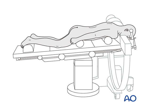 Patient in a prone position for approaches to C0–C7. The position allows AP and lateral x-rays.