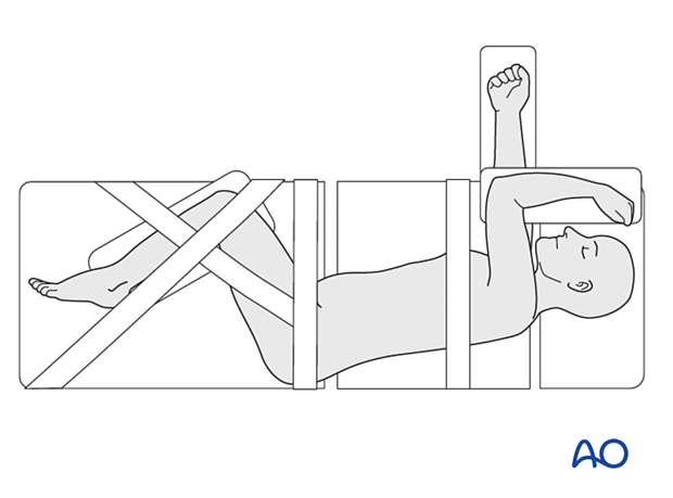 The patient is secured to the table by taping in the Lateral decubitus position for Lateral lumbar interbody fusion (LLIF).