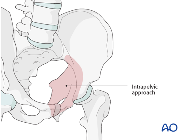 approach to the pubic symphysis