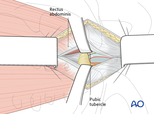 approach to the pubic symphysis