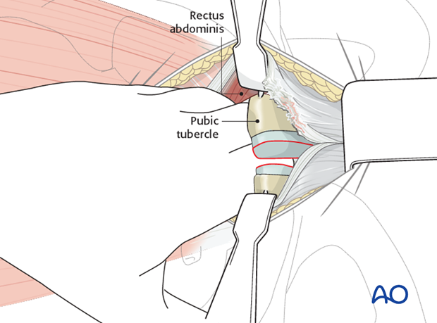 approach to the pubic symphysis