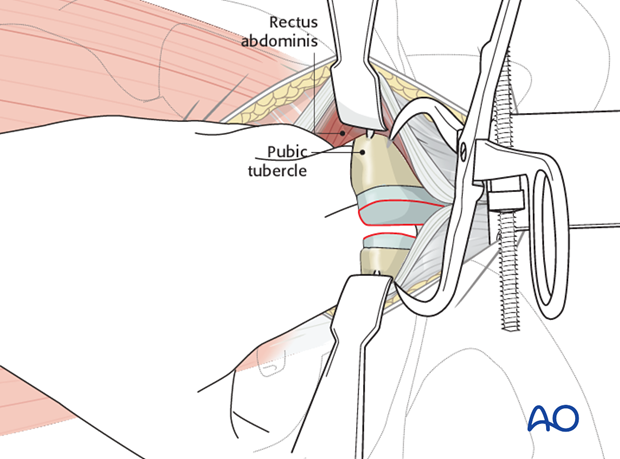 approach to the pubic symphysis