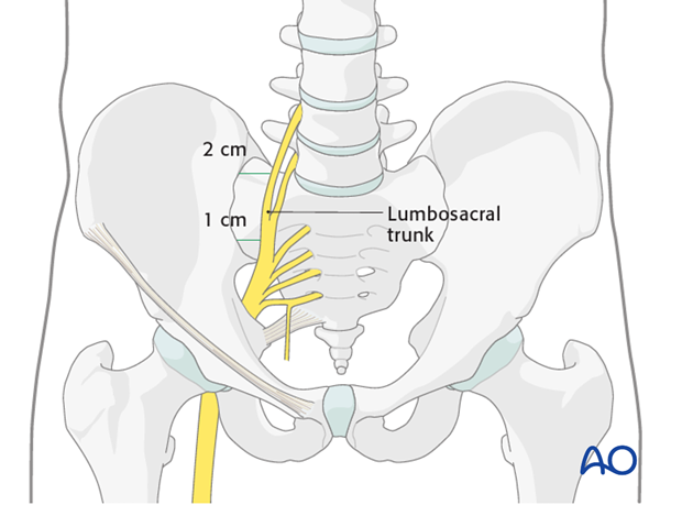 anterior approach to the iliac wing and si joint