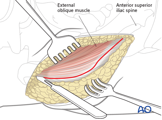 anterior approach to the iliac wing and si joint