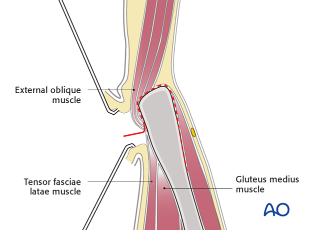 anterior approach to the iliac wing and si joint