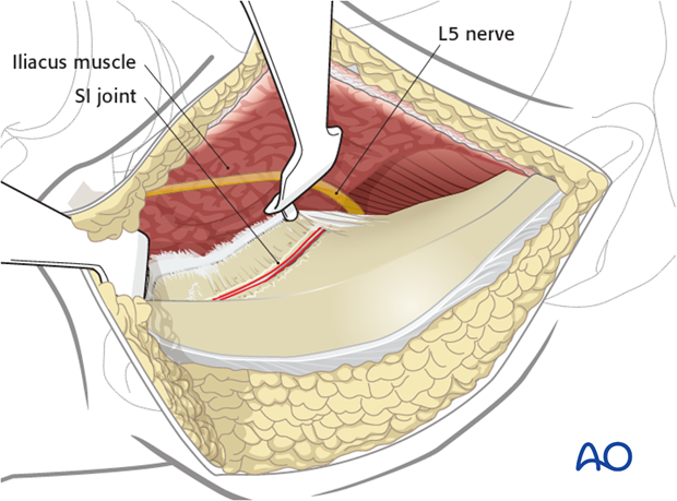 anterior approach to the iliac wing and si joint