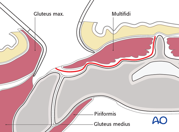 posterior approach to the si joint