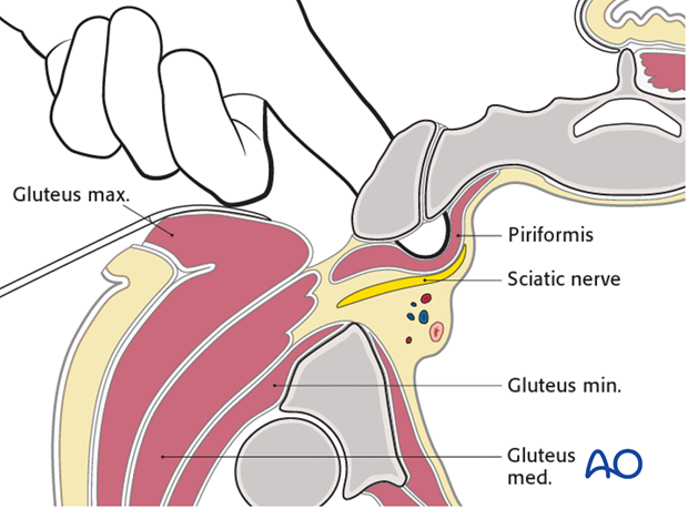 posterior approach to the si joint