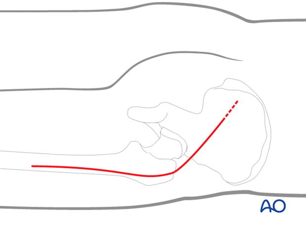 orif through sequential approaches