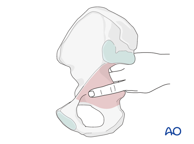 kocher langenbeck approach to the acetabulum