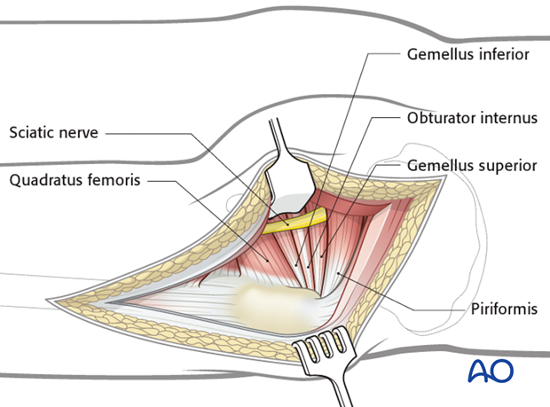 kocher langenbeck approach to the acetabulum