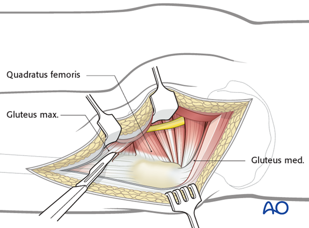 kocher langenbeck approach to the acetabulum