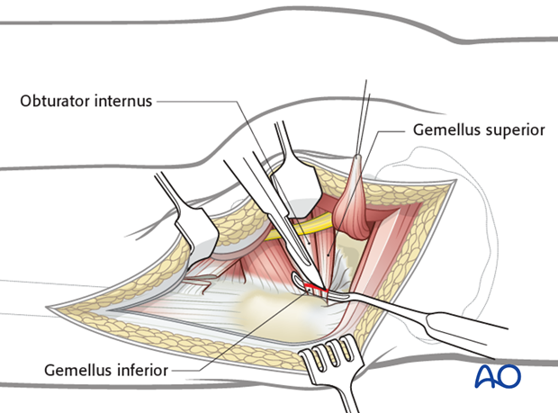 kocher langenbeck approach to the acetabulum