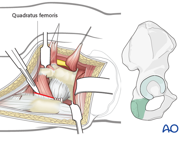 kocher langenbeck approach to the acetabulum