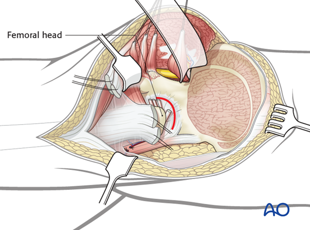 orif through extended iliofemoral approach