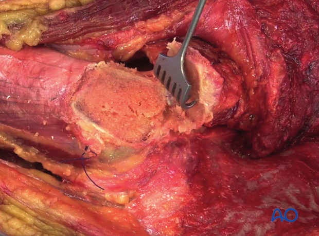 extended iliofemoral approach to the acetabulum