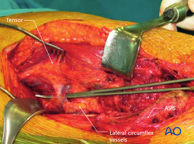 extended iliofemoral approach to the acetabulum